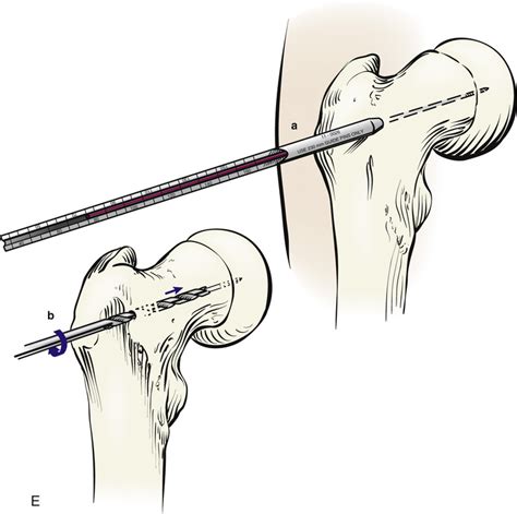 13 Percutaneous Cannulated Screw Fixation “pinning” Of Slipped