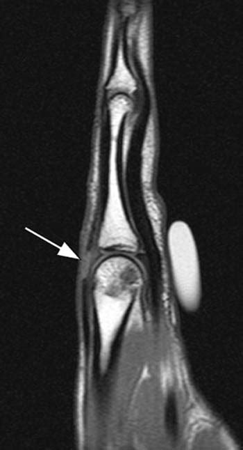 Extensor Tendon Injuries Of The Finger Radsource