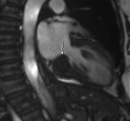 Caseous Calcification Of The Mitral Valve Annulus Image Radiopaedia Org