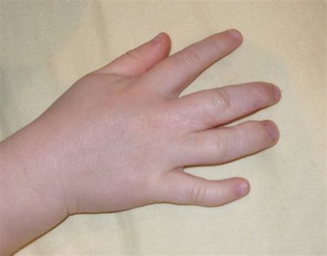 What Causes Swollen Hands In The Morning