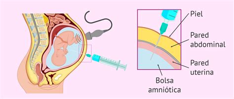 A Amniocentese é Um Método Invasivo Difundido No Diagnóstico Pré-natal