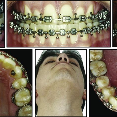 Presurgical Facial Photograph Of Mandibular Asymmetry And Intraoral