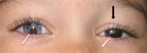 Bilateral Iris Coloboma With Heterochromia Indicated With Pink