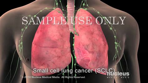 Small Cell Lung Cancer Staging YouTube