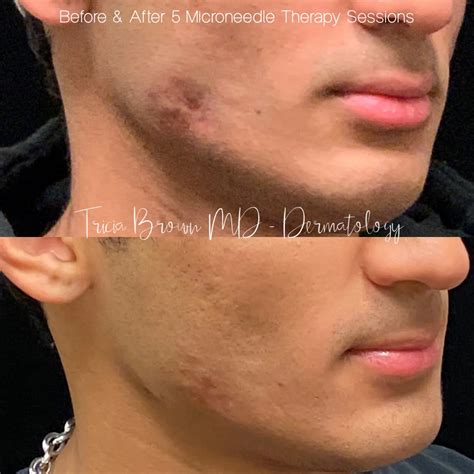 Acne Scarring Houston Tx Dermatologist
