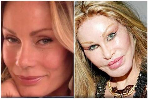 Celebrity Before And After Plastic Surgery Disasters Pop Hitz Celebrity Gossip News