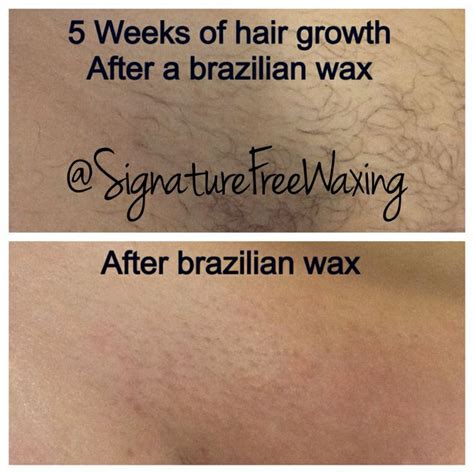 Top Photos 5 Weeks Of Hair Growth After Receiving A Brazilian Wax At