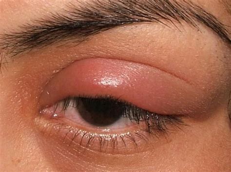 Stye Is An Eye Inflammation In Which The Lower Of Upper Eyelid Swells Due To The Bacterial