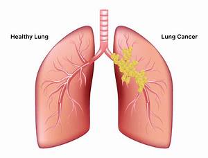 Lung Cancer - Symptoms, Causes, Treatment and Survival Rates Lung Cancer  