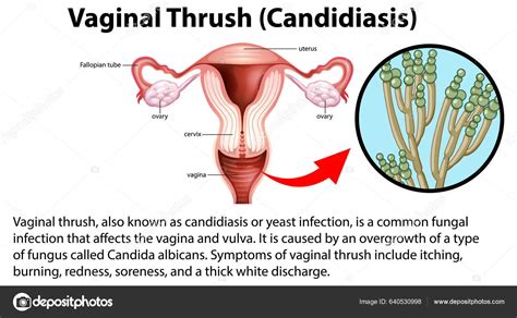 Vaginal Thrush Candidiasis Infographic Explanation Illustration Stock Vector By ©blueringmedia
