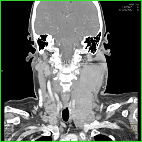 Lymphoma (historically lymphosarcoma was used for diffuse forms of the disease) is a malignancy arising from lymphocytes or lymphoblasts. Lymphoma with Massive Neck Adenopathy - Neuro Case Studies ...