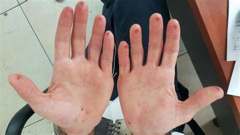 Photos Israeli Man Cuts Off Pads Of Fingers To Avoid Traffic Fees Via Fingerprints San