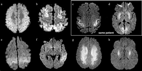 Figure 4 From Mri Patterns Of Global Hypoxic Ischemic Injury In Adults