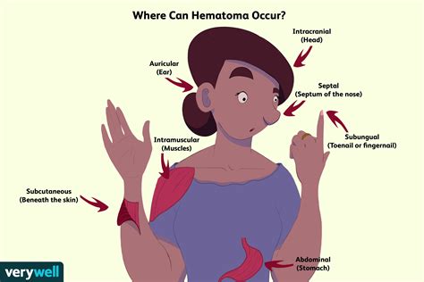 Hematoma Overview And More