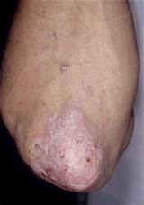 Is There A Treatment For Psoriasis Photos