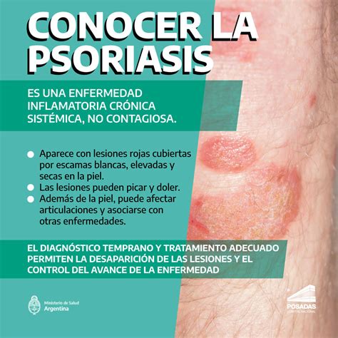 Top 167 Imagenes Psoriasis En La Cara Destinomexicomx