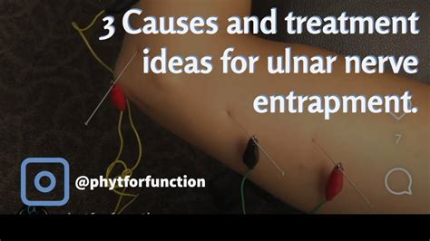 What Causes Ulnar Nerve Pain Ulnar Nerve Entrapment And Treatment