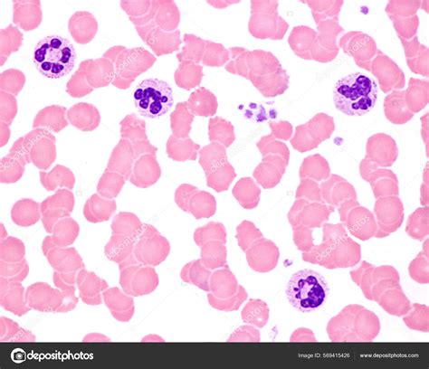 Human Blood Smear Leukocytosis Acute Infection Neutrophil Leukocytes