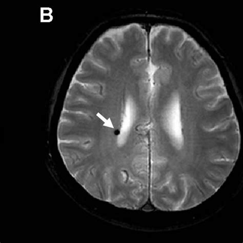 Cerebral Small Vessel