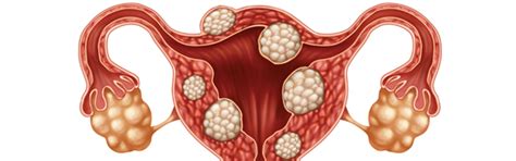 Uterine Fibroid Embolization In Lakeland Fl Lakeland Vascular Institute