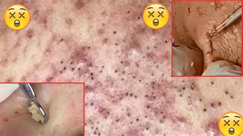 Cystic Acne Icd 10
