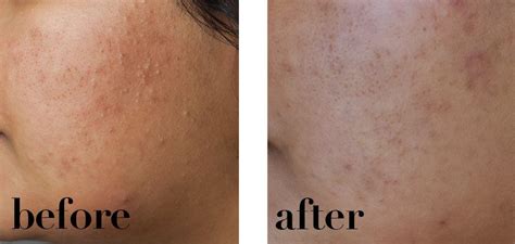 Apply to the face in the am and/or pm after cleansing and before moisturising. Deciem the Ordinary Niacinamide Serum