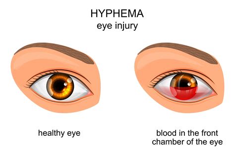 Understanding Hyphema Symptoms Treatment And More Nvision Eye Centers