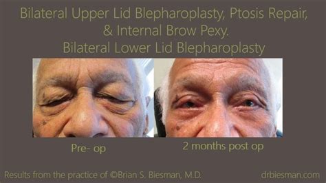 View The Before And After Gallery For Bul Bll Blepharoplasty From Real