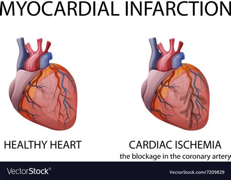 Heart Myocardial Infarction Royalty Free Vector Image