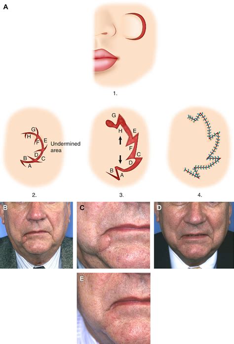Figure 6 From Scar Revision And Recontouring Post Mohs Surgery