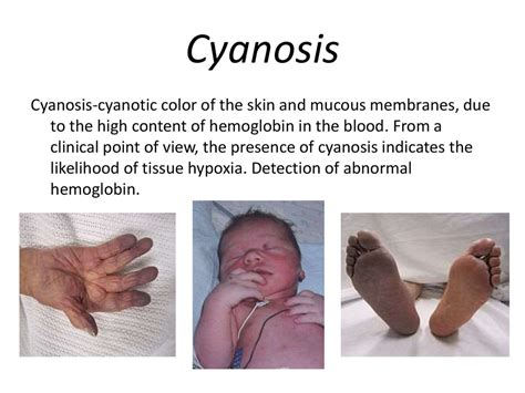 What Is Acute Cyanosis