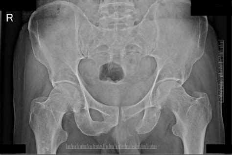 A Radiograph Of Pelvis Ap View Shows Osteolytic Areas In Left