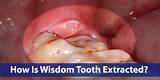 Photos of Emergency Tooth Extraction Cost