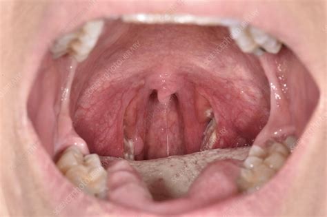 Streptococcal Tonsillitis Stock Image C Science Photo Library