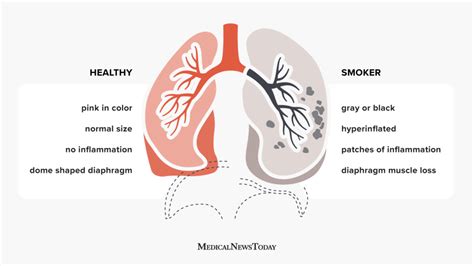 Comparison Model Between Smoking Alveoli And Healthy Alveoli In Human Body Human Lung Anatomy