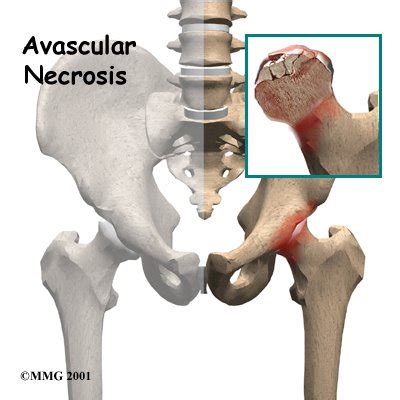 Physical Therapy In Conway For Avascular Necrosis Of The Hip