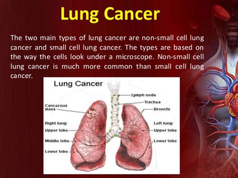 Cancer gives most people no symptoms or signs that exclusively indicate the disease. Lung Cancer Treatment in India