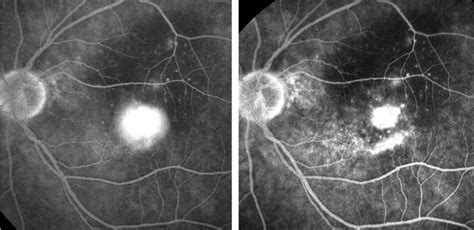 Photodynamic Therapy For Choroidal Neovascularization Secondary To