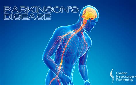 parkinson s disease london neurosurgery partnership