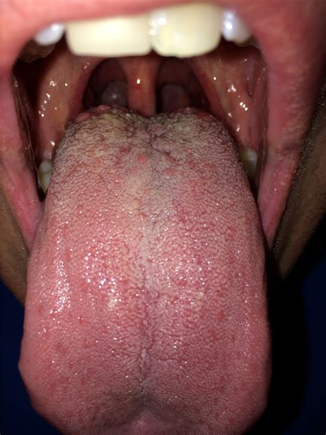 Male Oral Thrush Xxx Porn Library