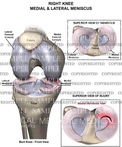 Medial Meniscus Tear Of Right Knee — Medical Art Works