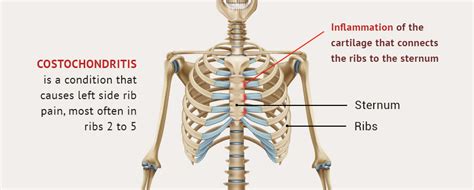 Picture Of What Is Under Your Rib Cage 8 Causes Of Pain Under The
