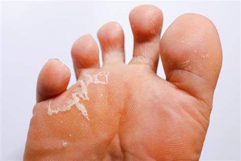 2000 Tinea Pedis Stock Photos Pictures And Royalty Free Images Istock