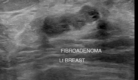 Fibroadenoma Of Breast Sono Scan 5d