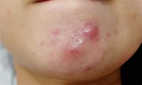 Pimples On Chin Small Big Itchy Or Painful Cause Skincarederm