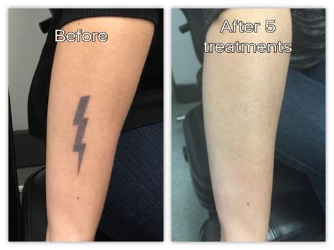 We did not find results for: Before & After — Disappearing Ink Laser Tattoo Removal