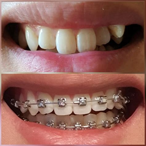 1 Year And 6 Months On The Damon System Rbraces