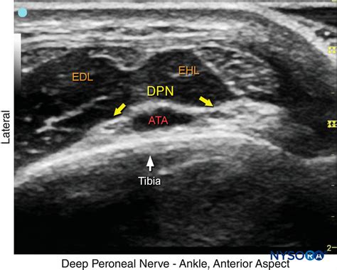 Regional Anesthesia Ultrasound Image Of The Deep Peroneal Nerve Nysora