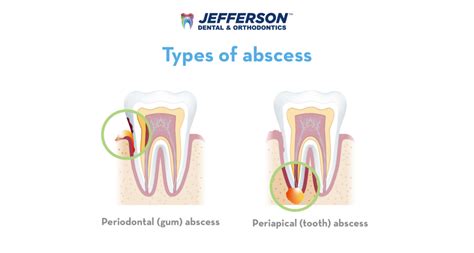 Abscessed Tooth Types Causes Symptoms And Treatment Jefferson