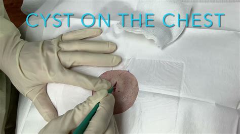 Cyst On The Chest At Coastal Dermatology And Medspa Youtube